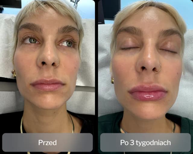 Kwas hialuronowy na co pomaga? Odkryj jego niezwykłe właściwości Kwas hialuronowy na co pomaga? Odkryj jego niezwykłe właściwości